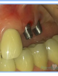 Multiple Dental Implants