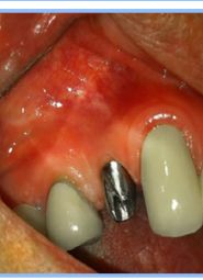 Single Dental Implant