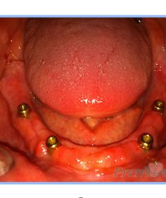 Overdenture 