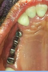 Multiple Dental Implants