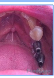 Multiple Dental Implants