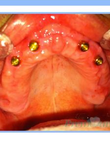 Overdenture 