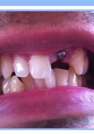 Single Dental Implant