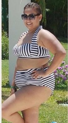 Weight-Loss Surgery