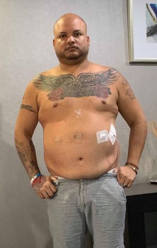 Weight-Loss Surgery