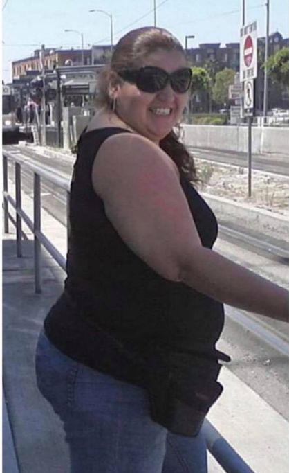 Weight-Loss Surgery