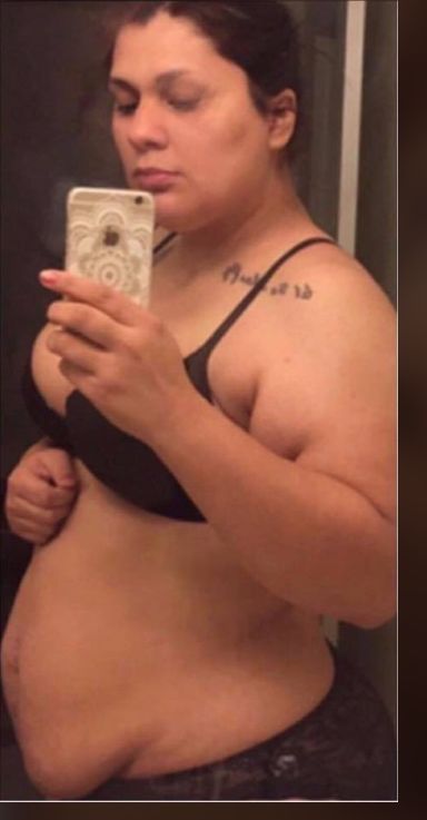 Weight-Loss Surgery