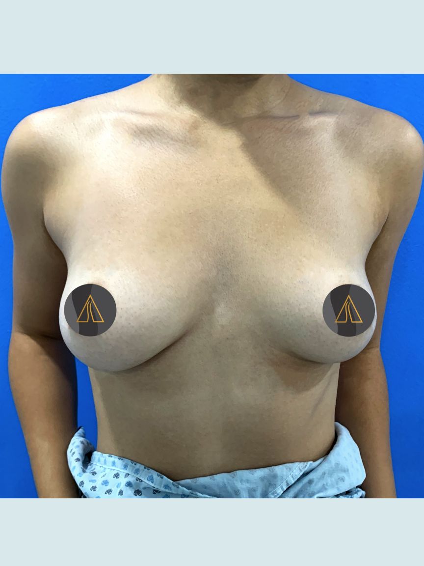 Breast Augmentation