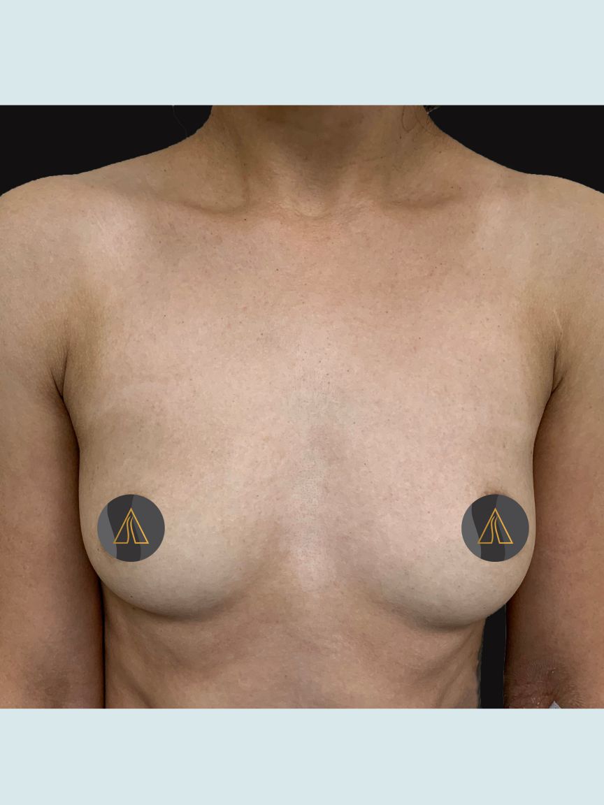 Breast Augmentation