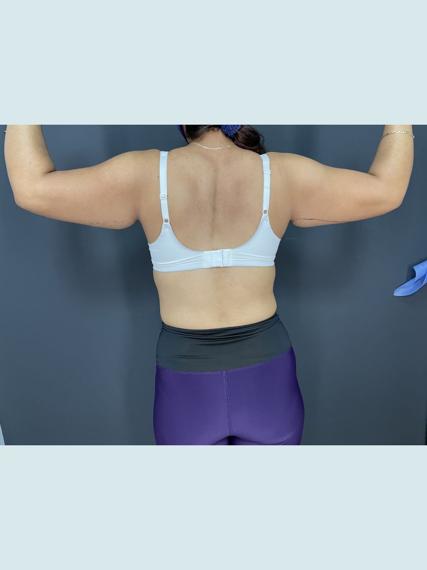 Arm Lift