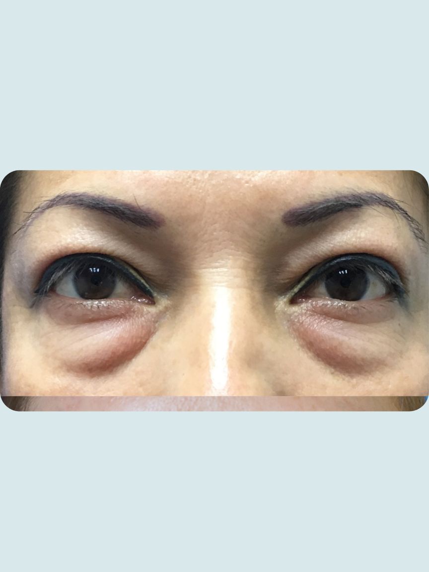 Blepharoplasty