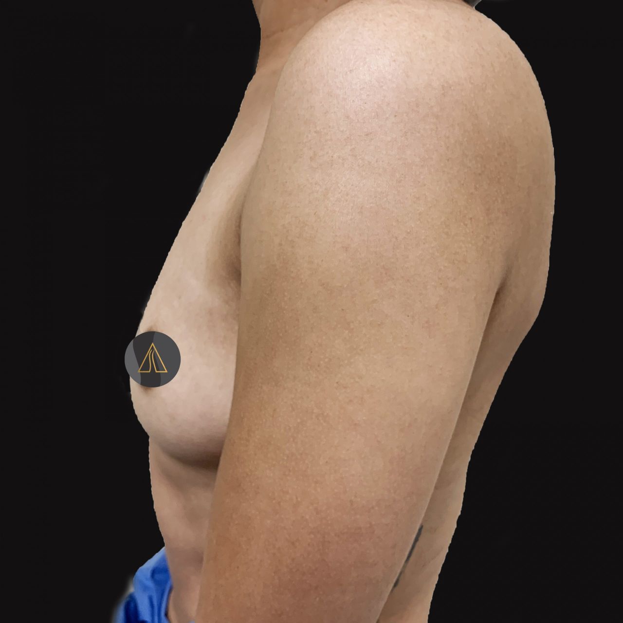 Breast Augmentation