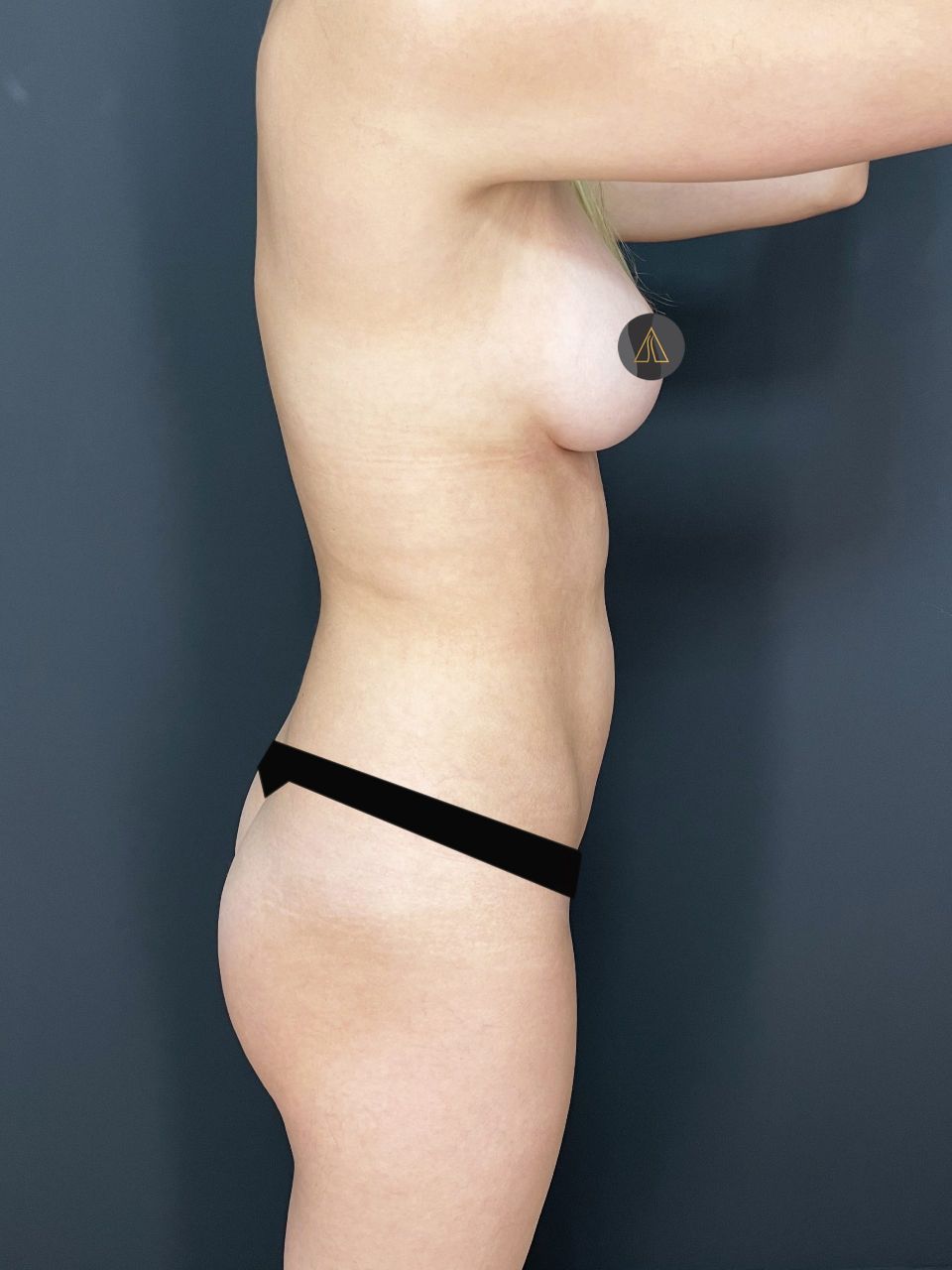 Liposuction w/ BBL