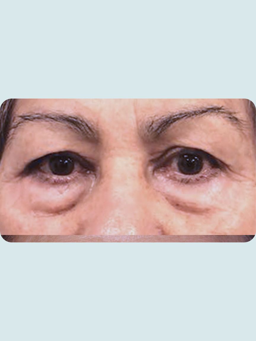 Blepharoplasty