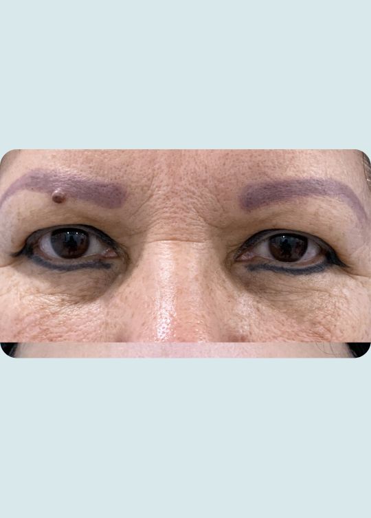 Blepharoplasty