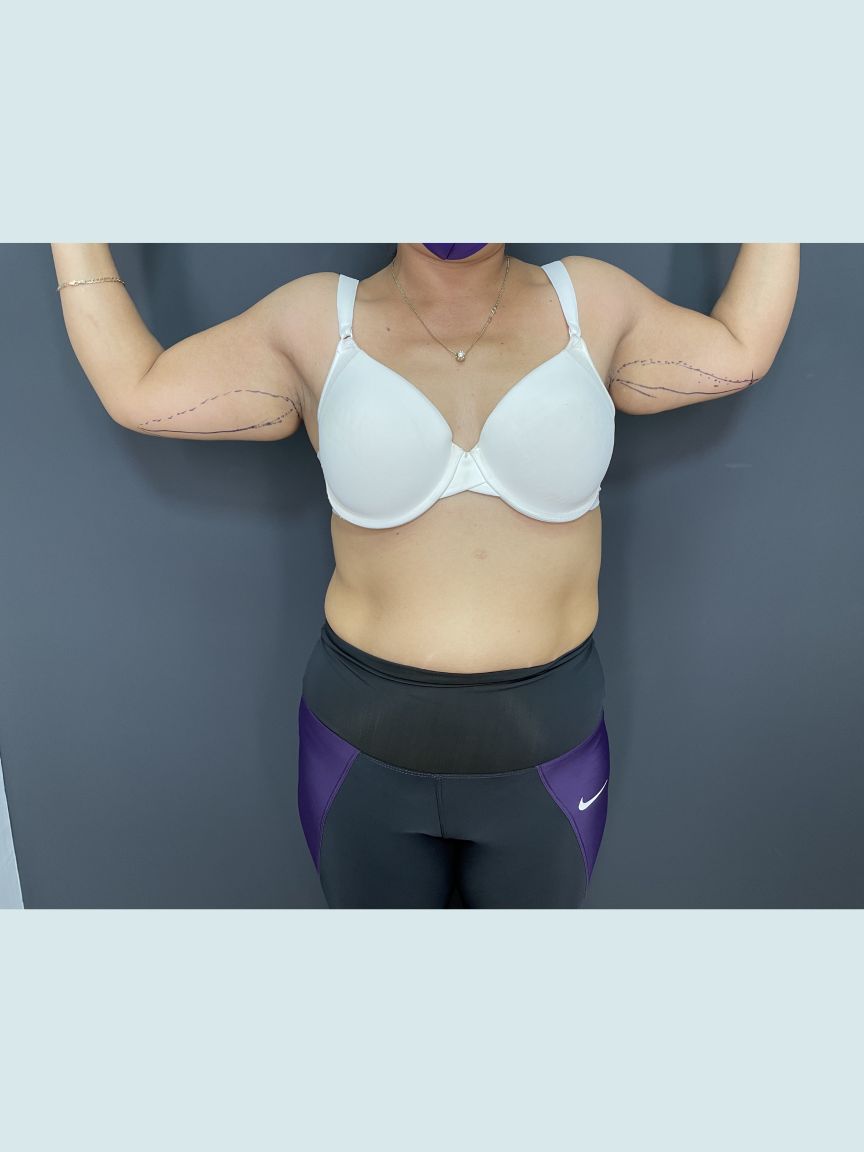 Arm Lift