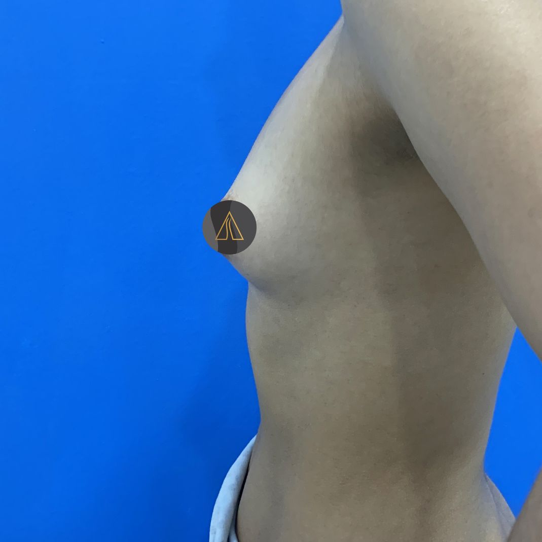 Breast Augmentation