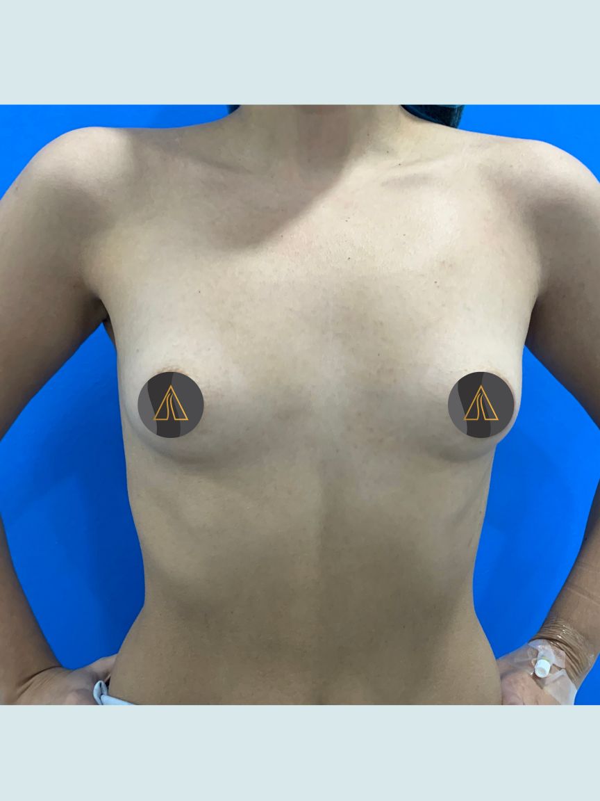Breast Augmentation