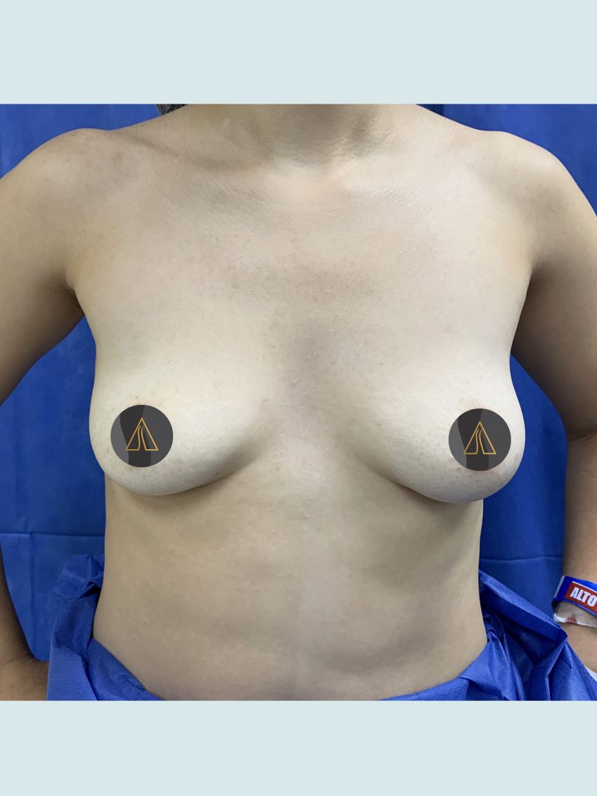 Breast Augmentation