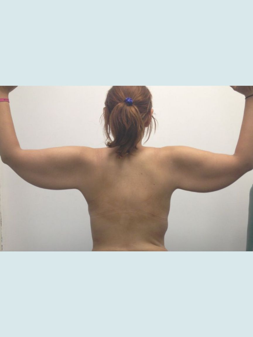 Arm Lift