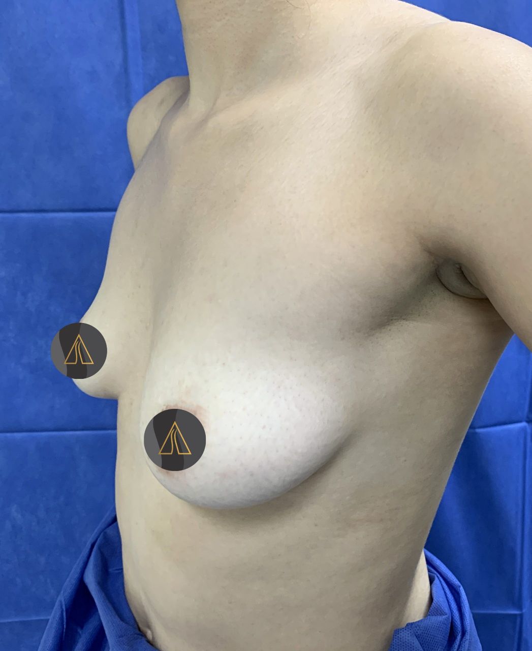 Breast Augmentation