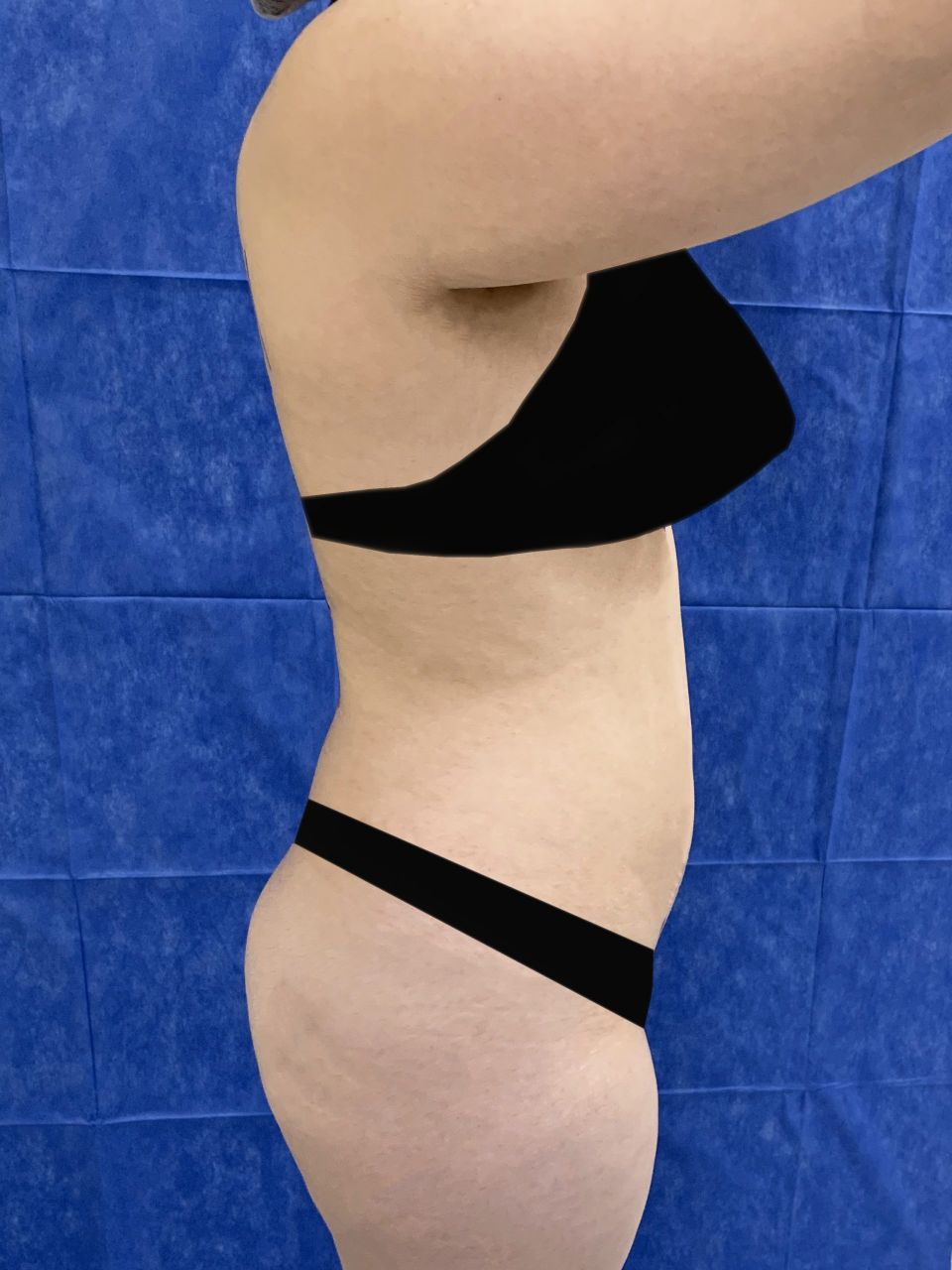 Liposuction w/ BBL