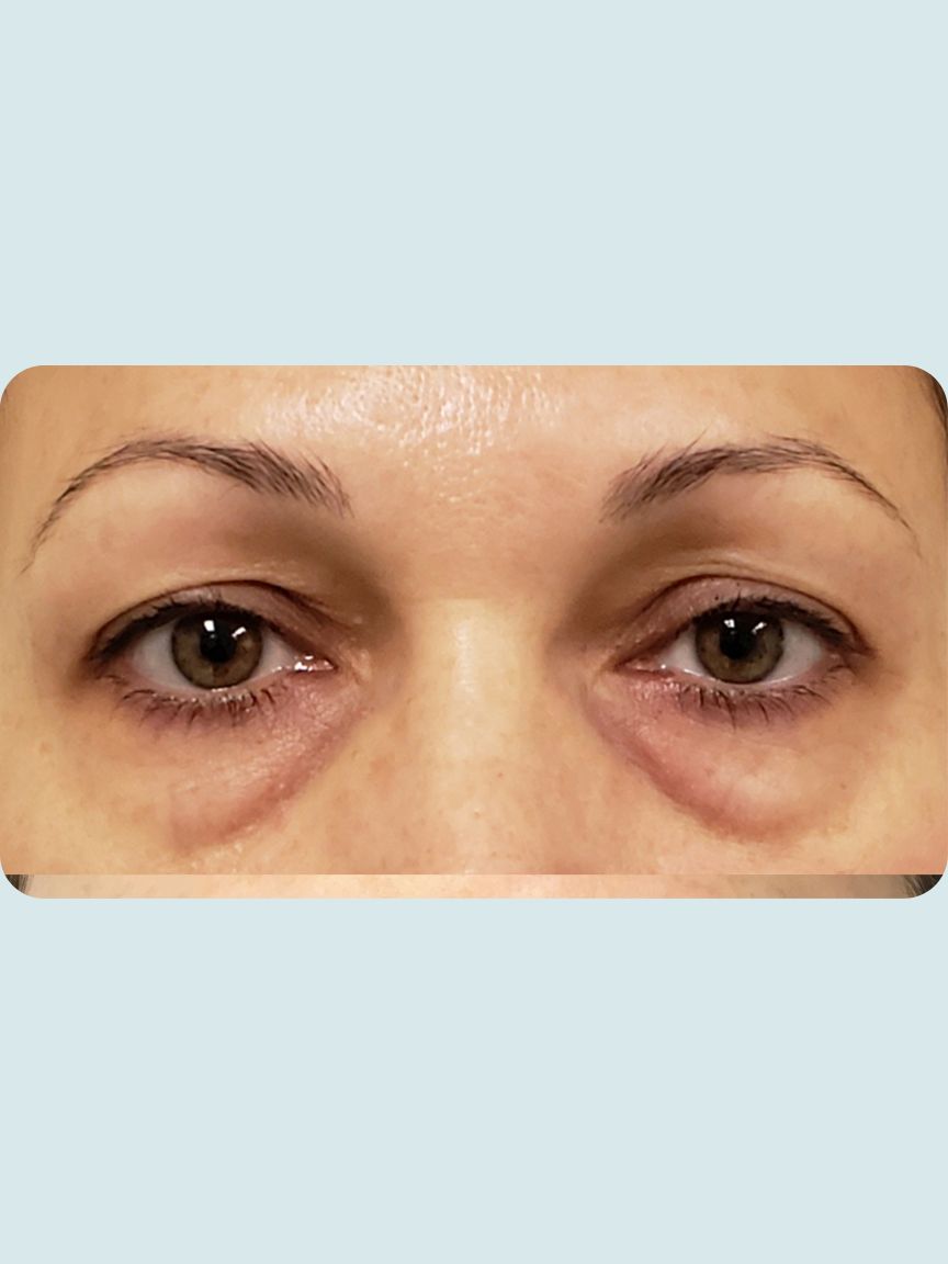 Blepharoplasty