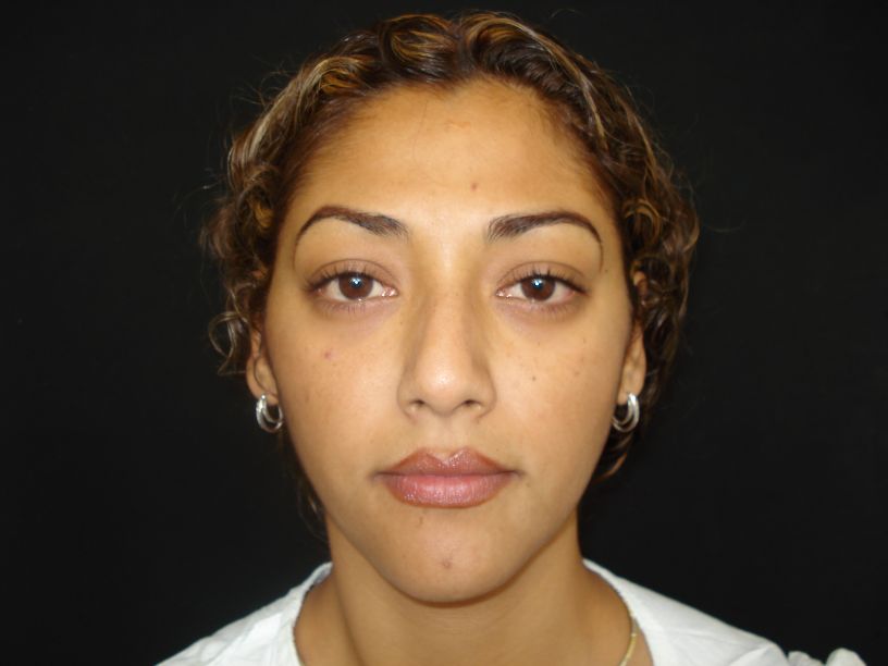 Rhinoplasty