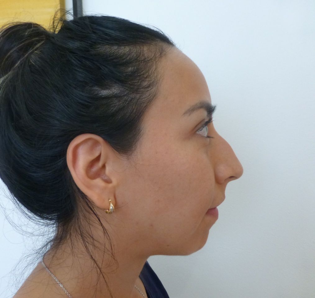 Rhinoplasty