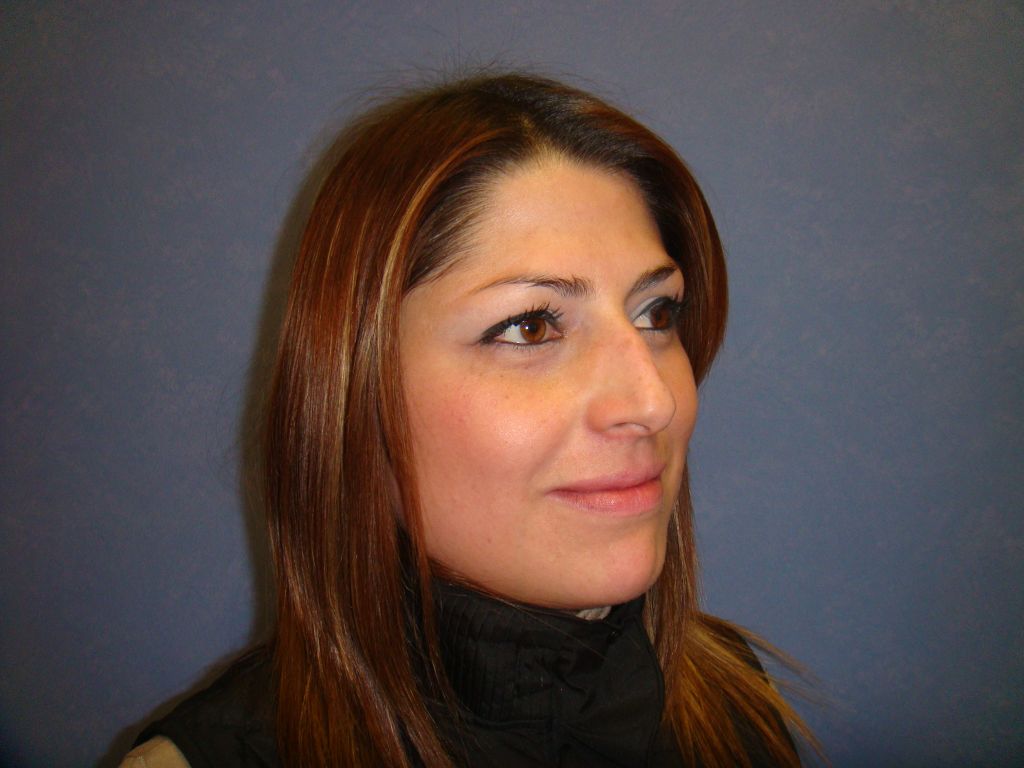 Rhinoplasty