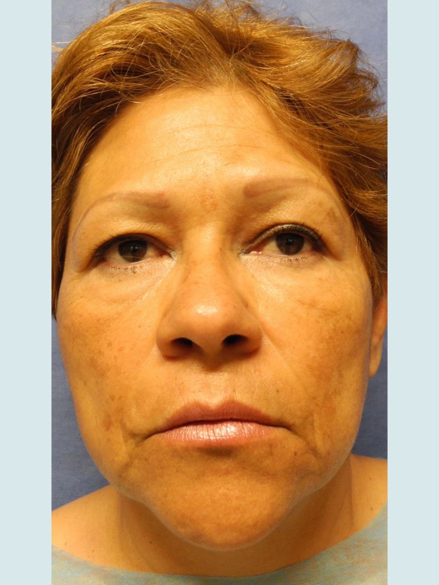 Facelift with Blepharoplasty