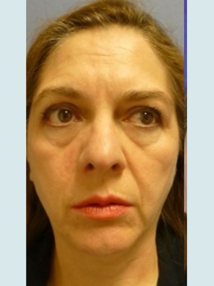 Facelift with Blepharoplasty