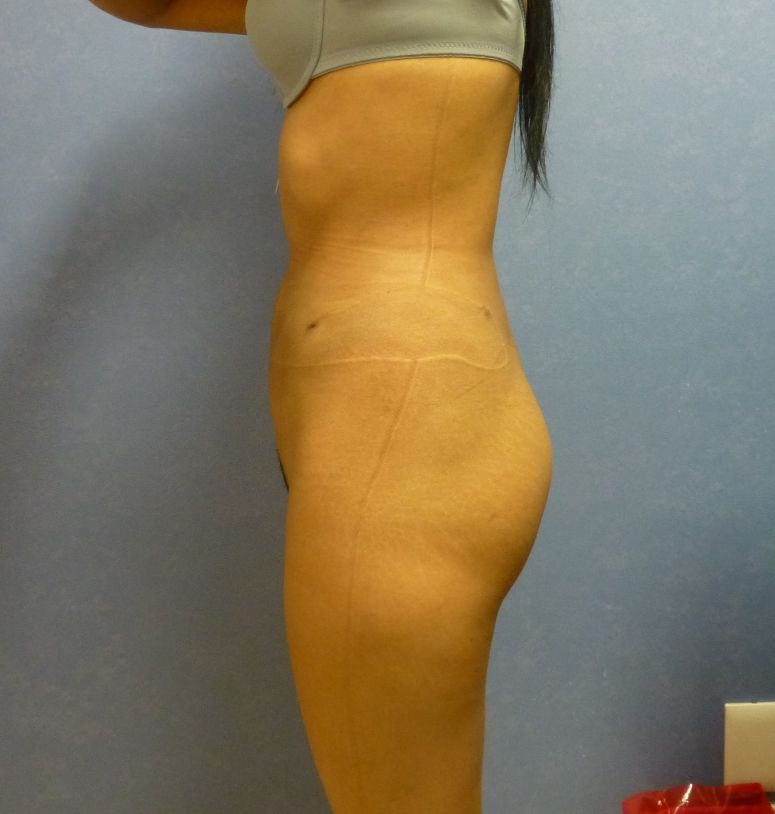 Brazilian Butt Lift