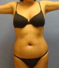 Liposuction