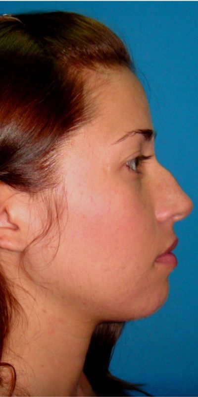 Rhinoplasty