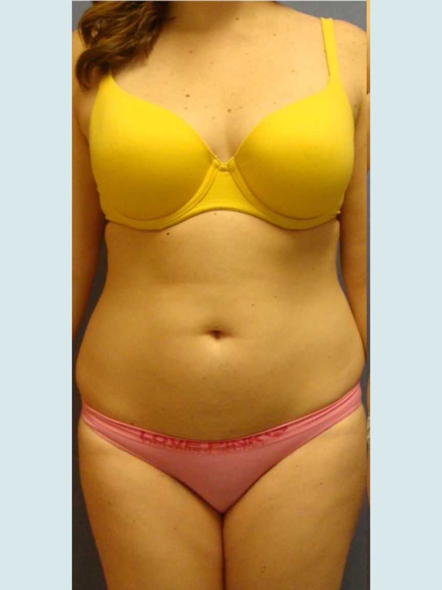 Liposuction