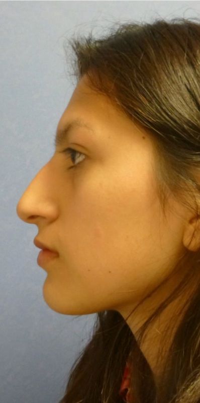 Rhinoplasty