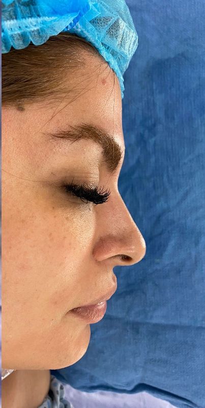 Rhinoplasty