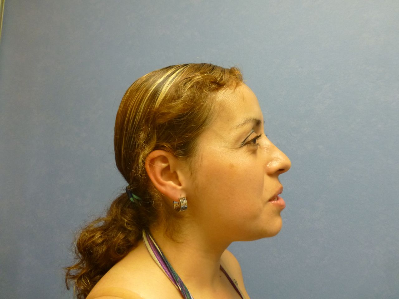 Rhinoplasty