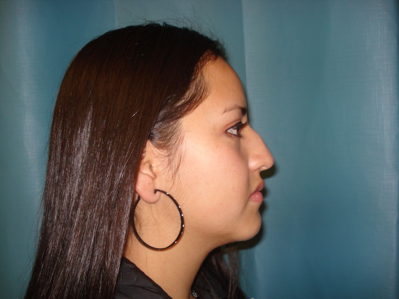 Rhinoplasty