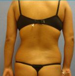 Liposuction