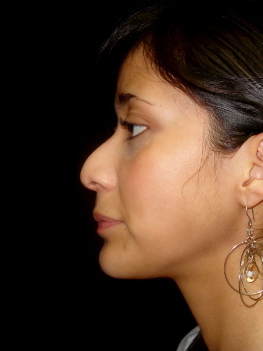 Rhinoplasty