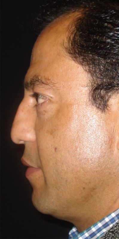 Rhinoplasty