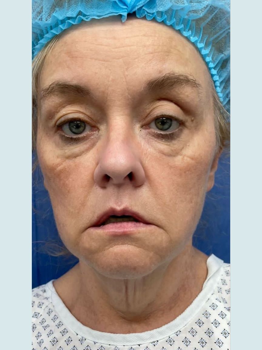 Facelift with Blepharoplasty