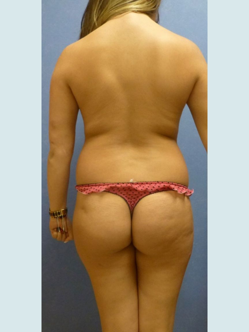 Liposuction w/ BBL