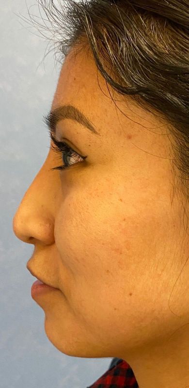 Rhinoplasty