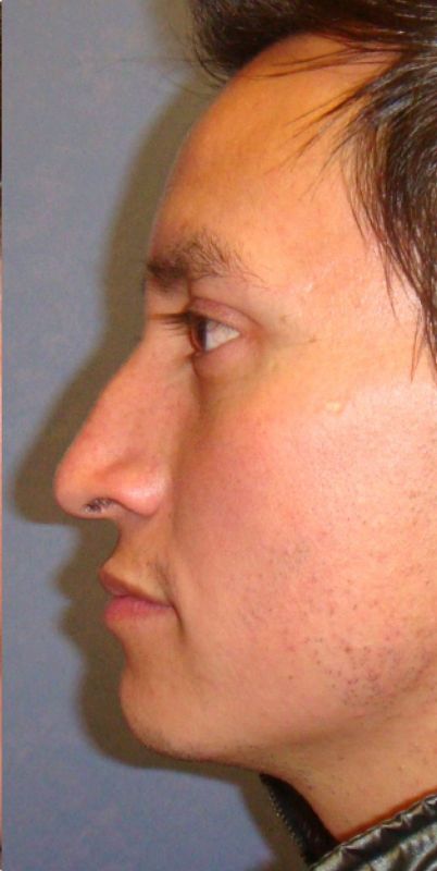 Rhinoplasty