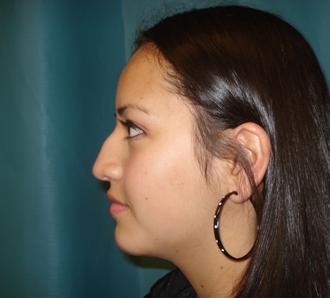 Rhinoplasty