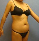 Liposuction
