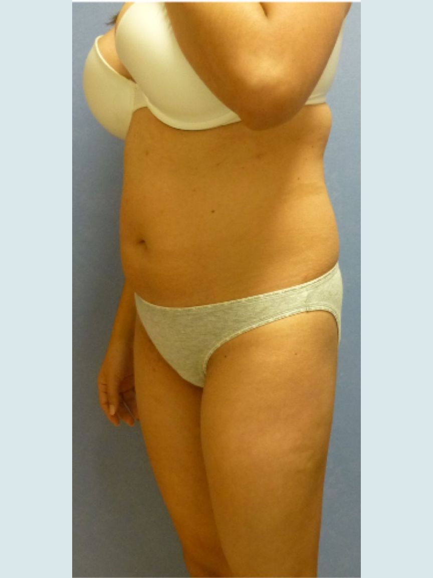 Liposuction